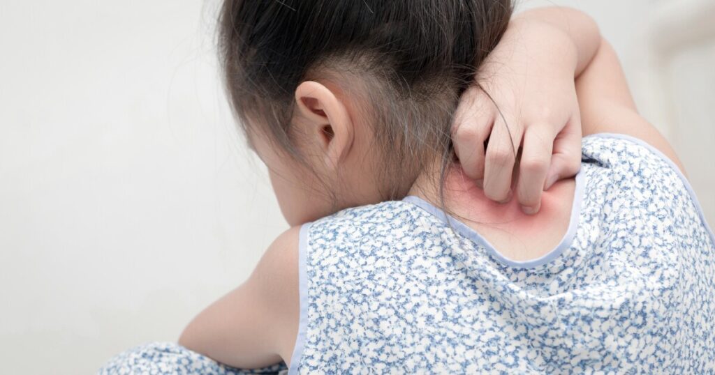 Triclosan exposure linked to allergies in children