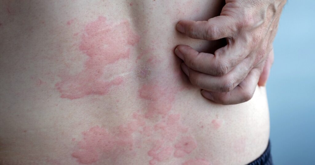 Best treatments for chronic hives beyond antihistamines
