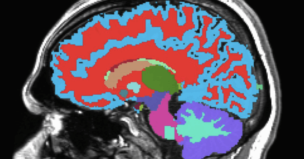 Midlife brain scan predicts future chronic diseases