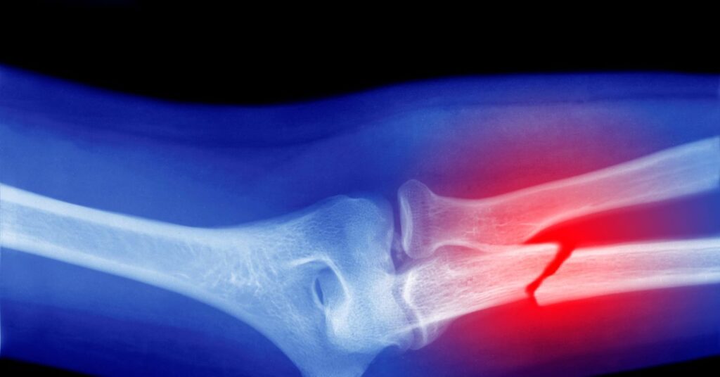 Microplastics Could Be Weakening Your Bones, Research Suggests