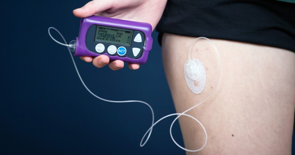 Transplant drug shows promise in slowing type 1 diabetes progression