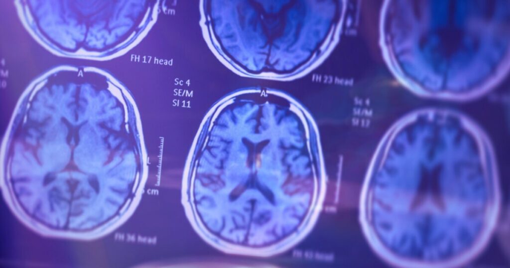 Early Alzheimer’s signs detected with blood tests
